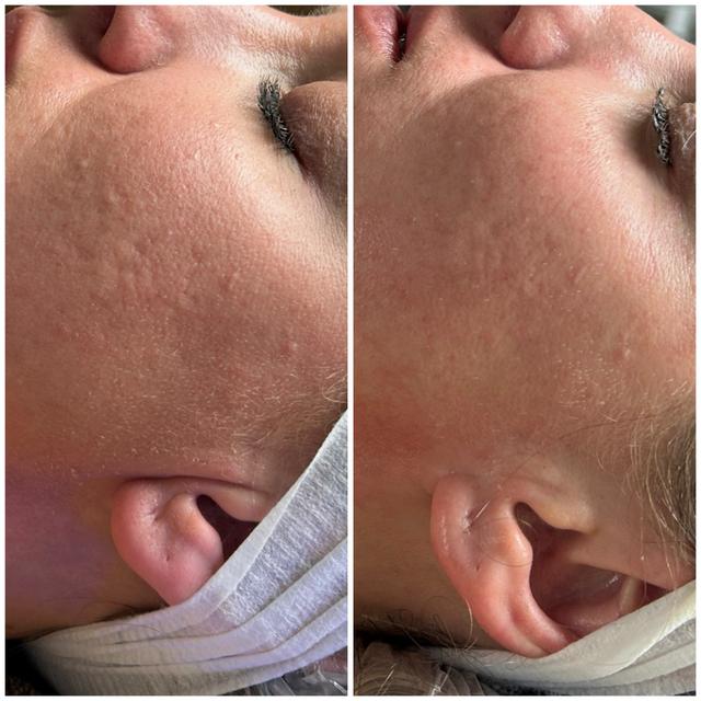 Non- Invasive Face Lift